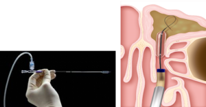 balloon catheters used to open the frontal sinus