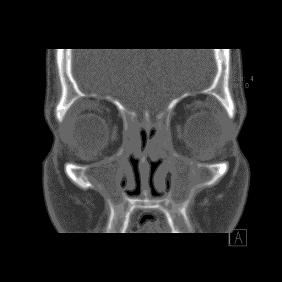 CAT scan showing sinusitis that involves the maxillary and ethmoid sinuses