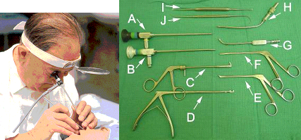 Doctor using special instruments to remove bone and mucosal disease tissue from infected sinuses.