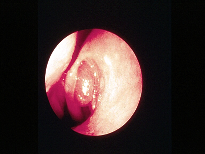 Endoscopic view of a nasal polyp