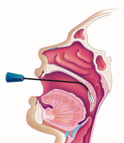 Coblation Snoring Treatment Being Performed