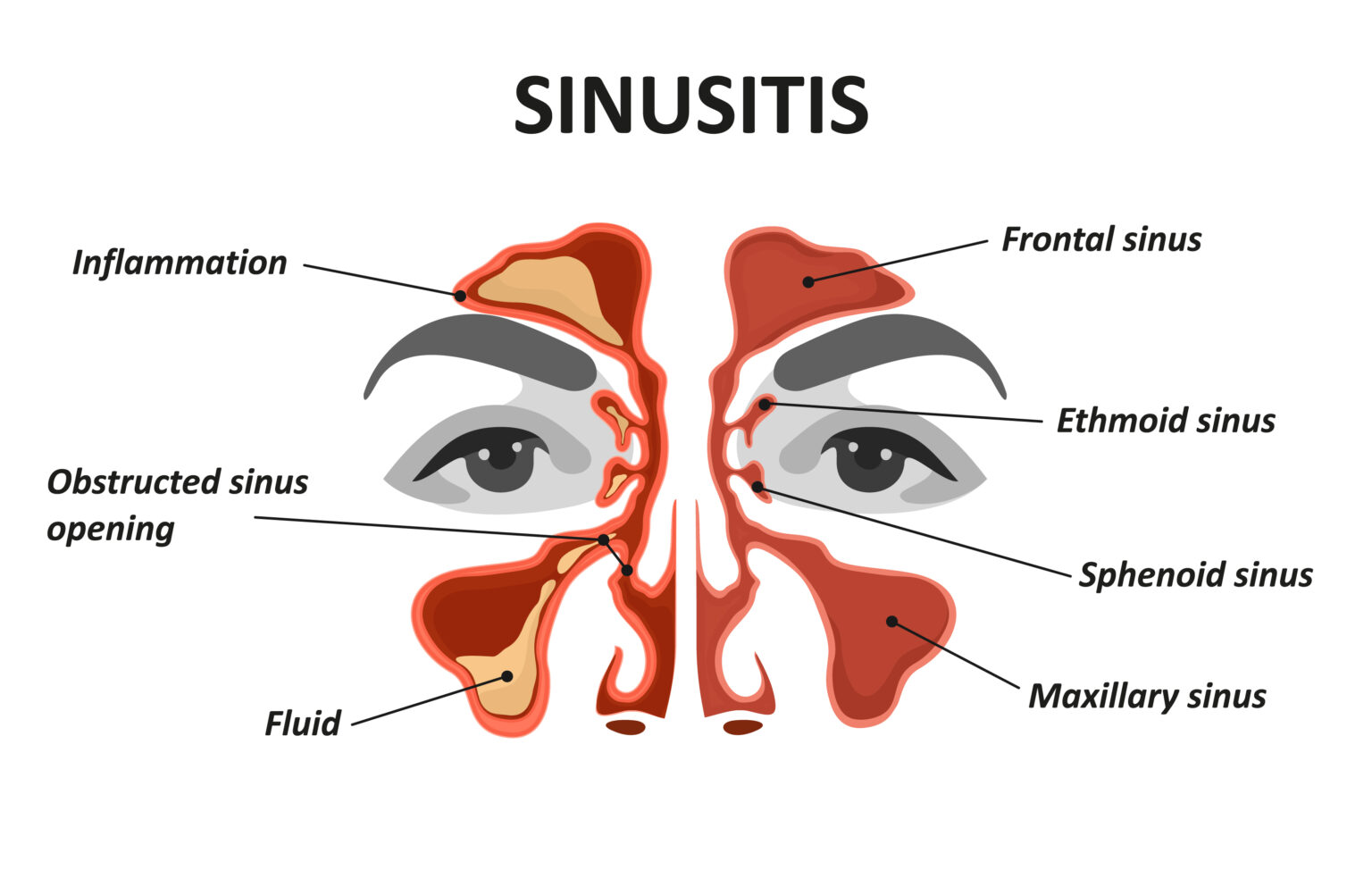 How Will I Know if My Child Has Sinus Problems? Maryland ENT