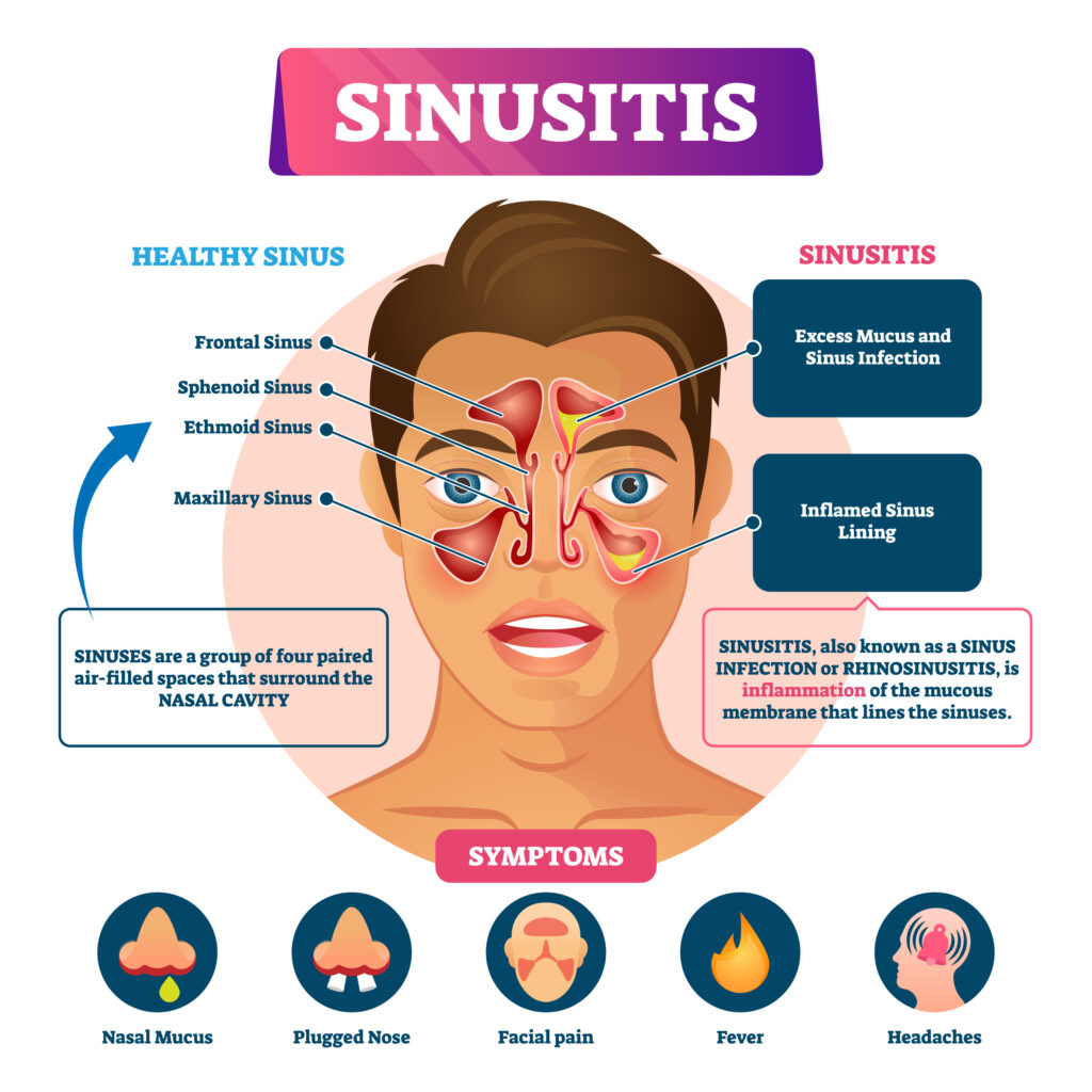 diagram of sinusitis