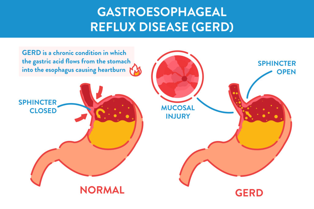 anatomy of GERD