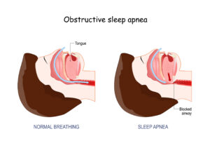 diagram of obstructive sleep apnea