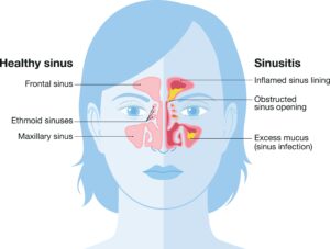 sinus canal infection