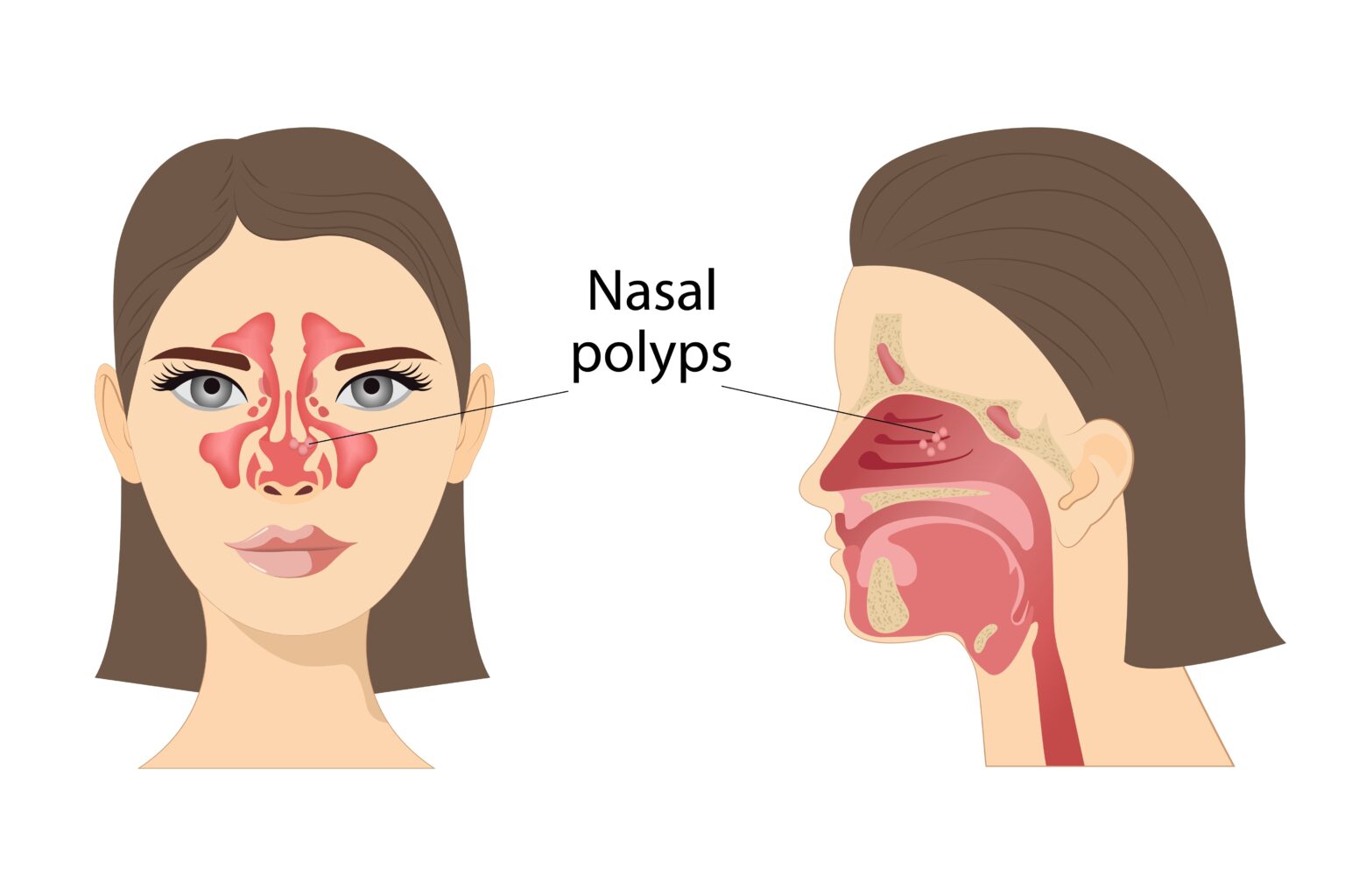 7 Signs You May Have Nasal Polyps Maryland ENT