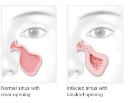 Chart Illustrating a Normal sinus with clear opening and an infected sinus with a blocked opening