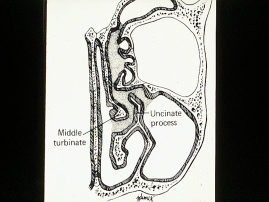 Ostiomeatal complex obstruction